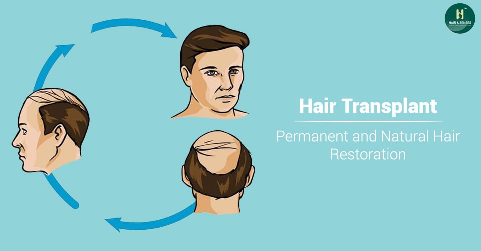 Natural hair transplant